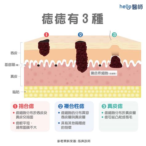 有問題的痣|痣形成的原因？痣長毛、痣變多變大是痣病變？5招判。